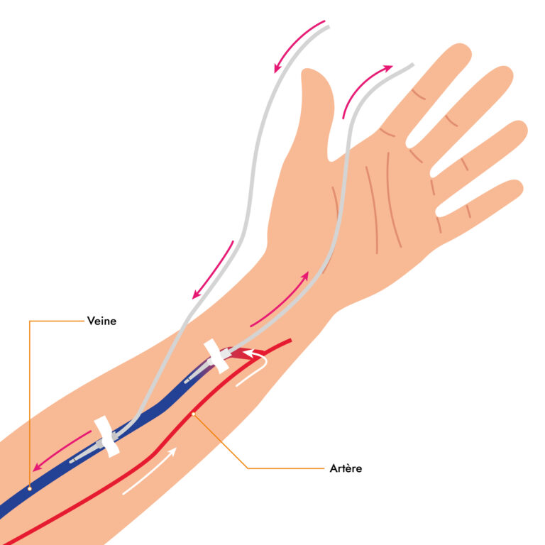 La dialyse à domicile L